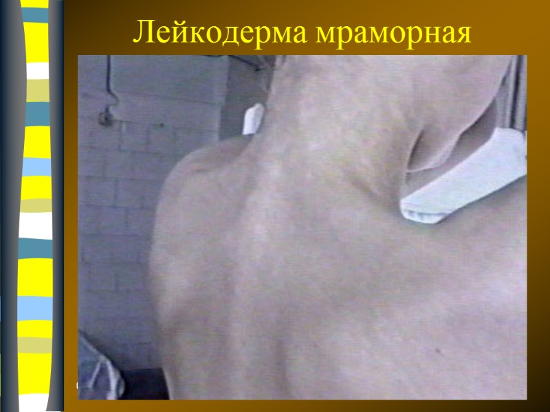 09.12.2017 Лейкодерма мраморная